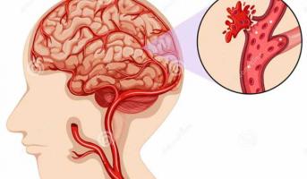 Thực phẩm chức năng hỗ trợ điều trị tai biến mạch máu não tốt nhất hiện nay