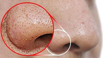 Cách trị mụn đầu đen tại nhà hiệu quả nhất bạn nên thử