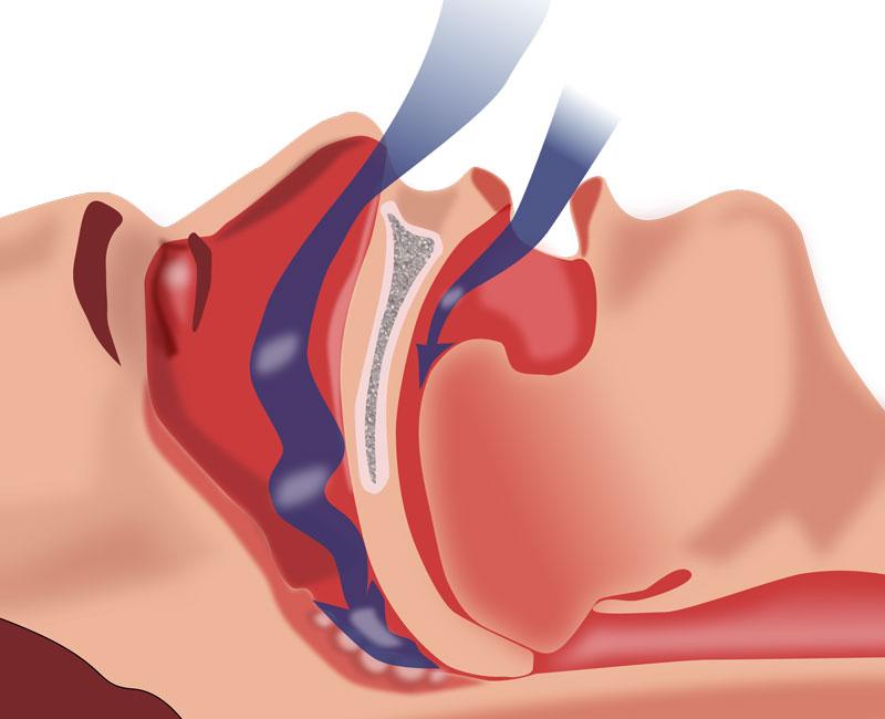 Bạn có thể mắc chứng ngưng thở khi ngủ (Obstructive Sleep Apnea – OSA)