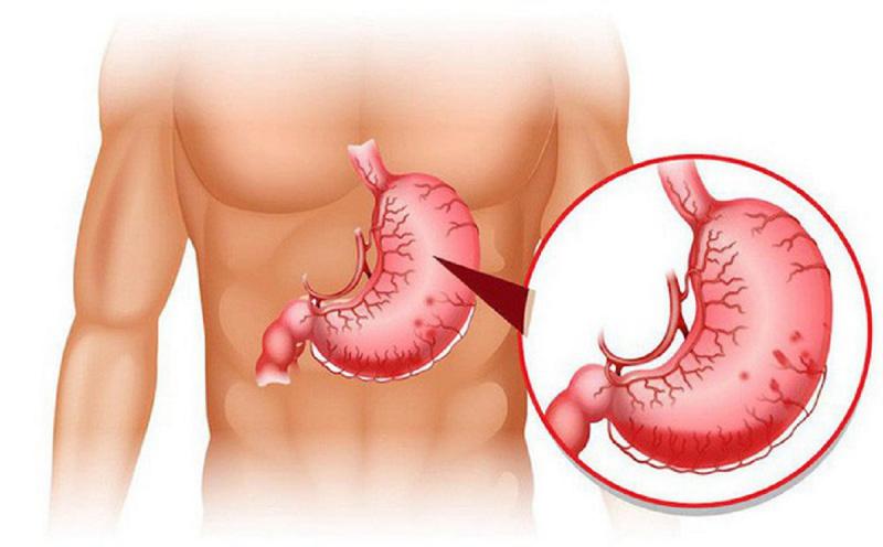 Bệnh dạ dày phì đại (Bệnh Ménétrier)