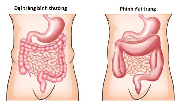 Bệnh phình đại tràng bẩm sinh (Hirschsprung)