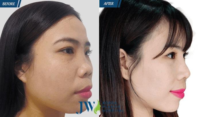 Bệnh Viện Thẩm Mỹ JW Hàn Quốc