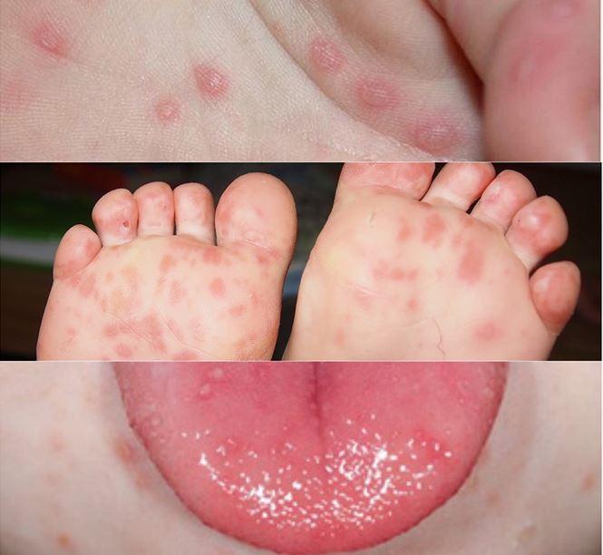 Dấu hiệu nhận biết bệnh tay chân miệng ở trẻ nhỏ