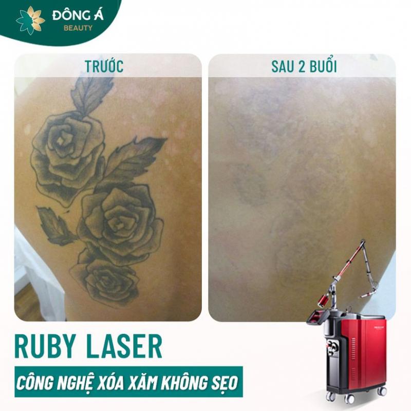 Thẩm mỹ viện Đông Á xóa hình xăm bằng công nghệ Ruby Laser với bước sóng ngắn