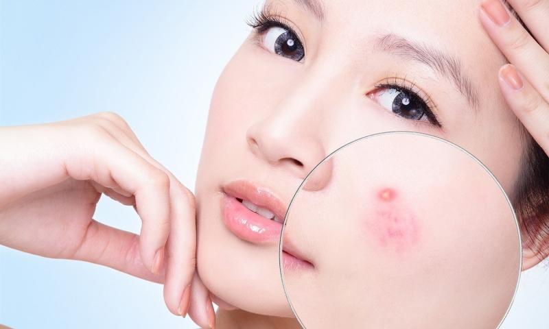 Ăn việt quất sẽ hỗ trợ trị mụn cực thần kì