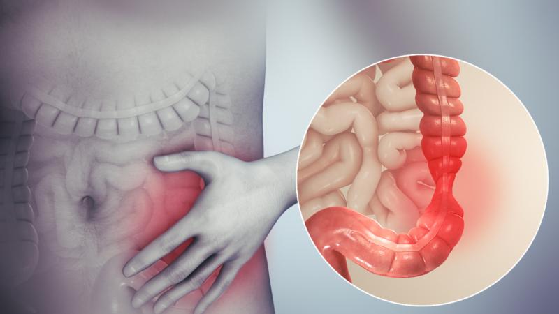 Hội chứng ruột kích thích