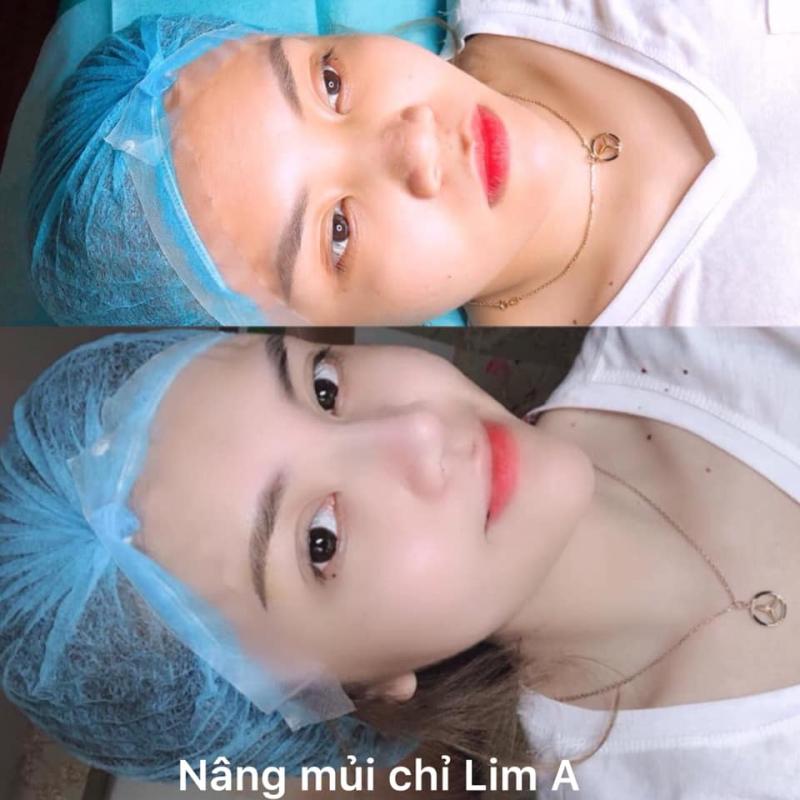 Thẩm Mỹ Quốc Tế Lim A