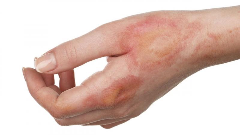 Kem đánh răng có tác dụng làm dịu vết bỏng