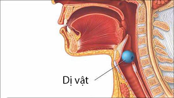 Nếu thức ăn lọt vào đường thở của bạn