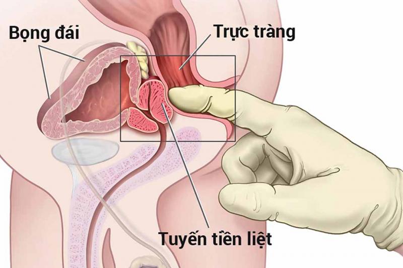 Tầm soát ung thư tuyến tiền liệt