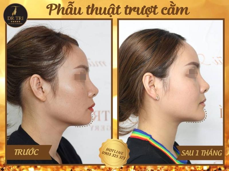 Hiệu quả trong thấy sau khi được trượt cằm tại  Tiến Sĩ Bác Sĩ Đỗ Thành Trí - Phẫu thuật Thẩm mỹ