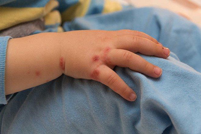 Đây là dấu hiệu sớm của bệnh tay chân miệng thể nặng