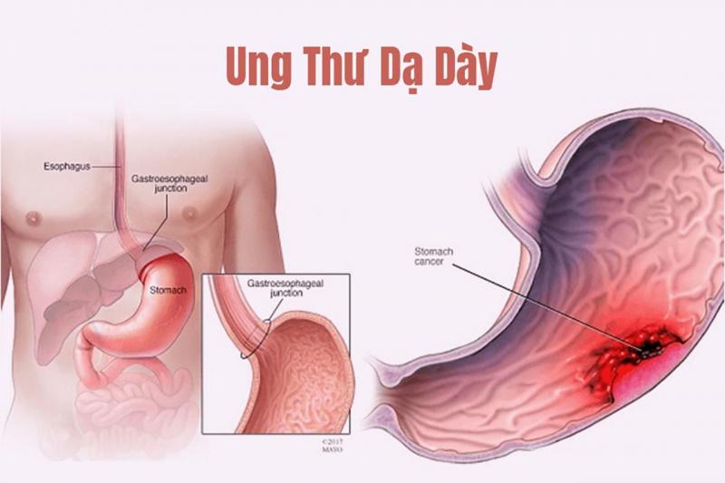 Đối tượng cần làm xét nghiệm ung thư dạ dày